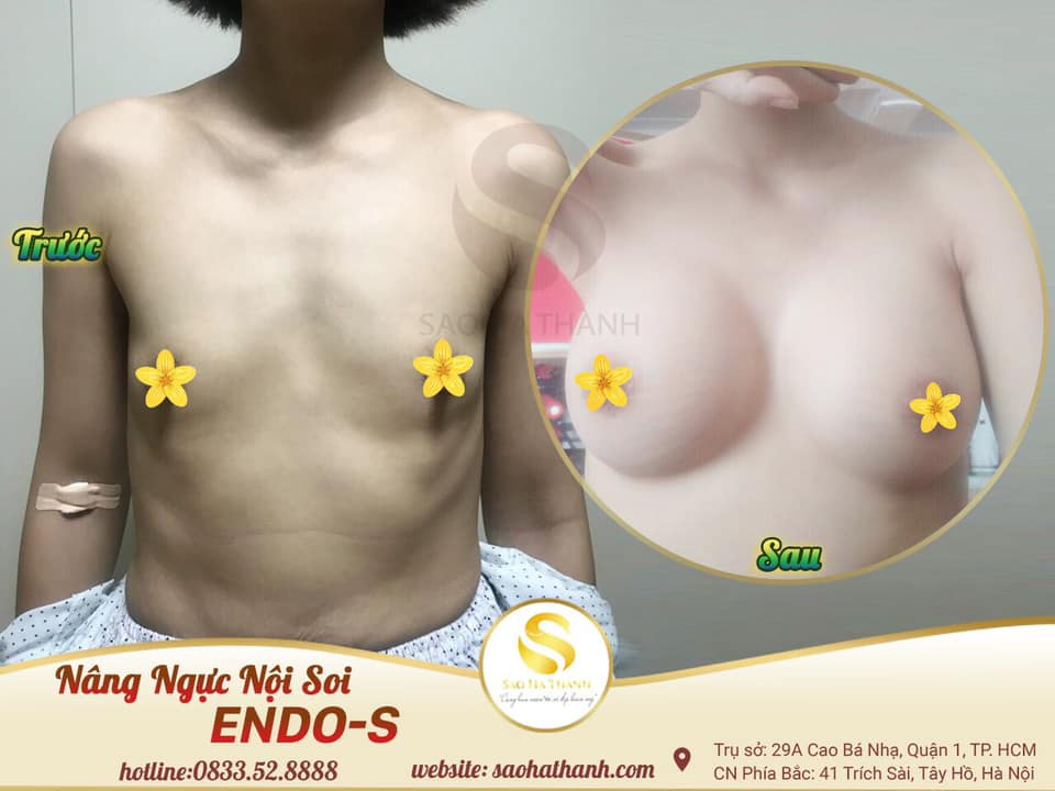 Nâng ngực nội soi Endo-S